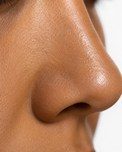 Piel facial con brillo localizado, poros visibles y exceso de sebo